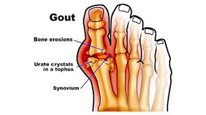 gout problem